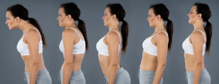 melbourne chiropractor postural problems text neck hyperkyphosis flat back swayback